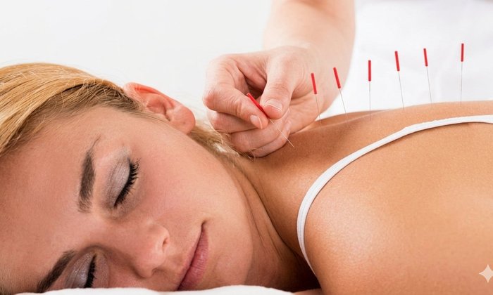 Acupuncture Treatment
